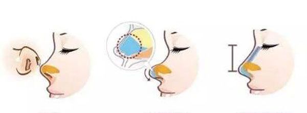 耳軟骨隆鼻三年吸收掉了，是真是假