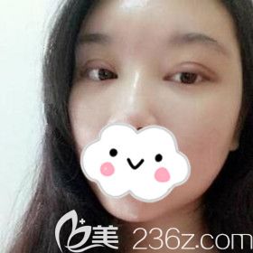 在懷化割雙眼皮術(shù)后10天恢復(fù)<span style=