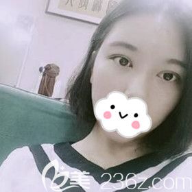 看我在懷化韓美醫(yī)療美容做的全切雙眼皮術(shù)后60天恢復(fù)效果還不錯(cuò)吧！