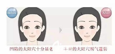 太陽穴凹陷和飽滿的區(qū)別