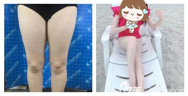 南寧美麗焦點劉晉艷做大腿抽脂案例效果
