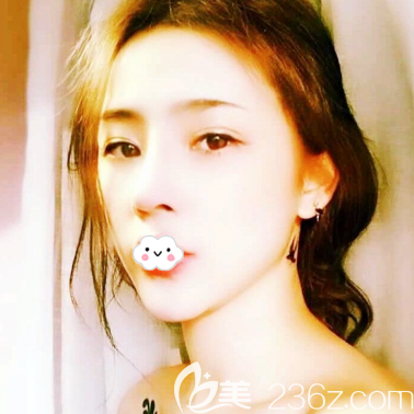 深圳潤澤瑞尼絲劉庚做脂肪填充怎么樣 深圳潤澤瑞尼絲劉庚做脂肪填充怎么樣