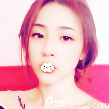 全臉脂肪填充術(shù)后一個月消腫恢復(fù)自然 全臉脂肪填充術(shù)后一個月消腫恢復(fù)自然