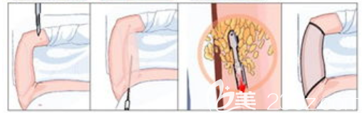 手臂抽脂過程圖