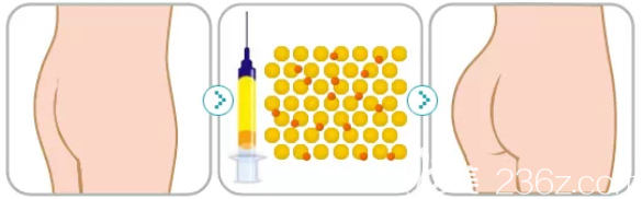 自體脂肪豐臀圖解