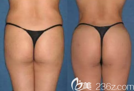 自體脂肪豐臀對比圖