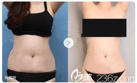 蘇州地區(qū)腹部減肥前后對(duì)比照
