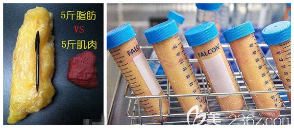 抽脂十斤的圖片對(duì)比