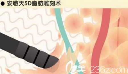 韓國安敬天5D脂肪雕刻術(shù)