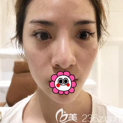 寧波薇琳做鼻子前鼻頭肥大 寧波薇琳做鼻子前鼻頭肥大