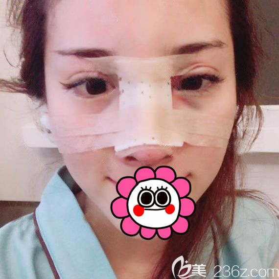 到寧波薇琳做完耳軟骨鼻綜合術(shù)后 到寧波薇琳做完耳軟骨鼻綜合術(shù)后