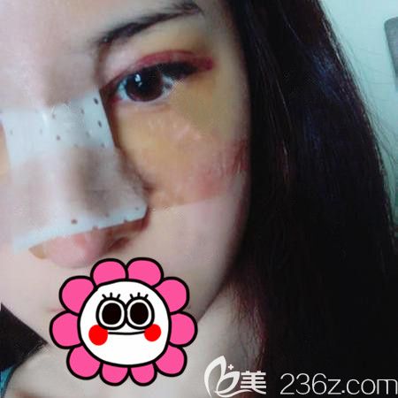 耳軟骨隆鼻恢復(fù)后四天<span style= 耳軟骨隆鼻恢復(fù)后四天<span style=