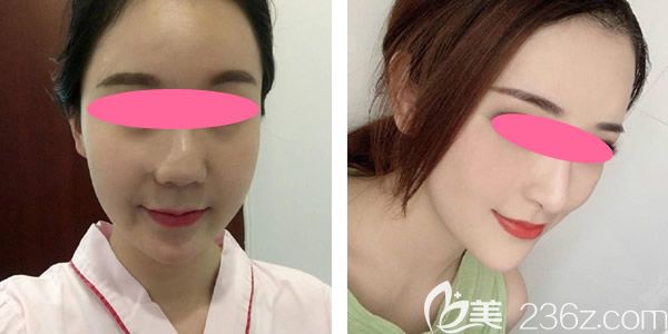 我打過鼻頭疤痕軟化針前后對(duì)比效果圖 我打過鼻頭疤痕軟化針前后對(duì)比效果圖