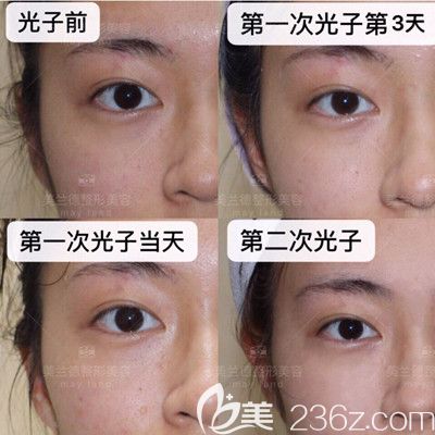 駐馬店美蘭德整形光子嫩膚真人案例 駐馬店美蘭德整形光子嫩膚真人案例