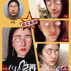 項利姣院長做自體脂肪面部填充移植術(shù)前術(shù)后效果對比