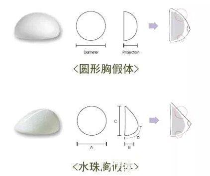 圓形、水滴形胸假體形狀示意圖