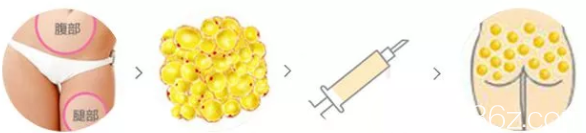 自體脂肪豐臀手術(shù)過程