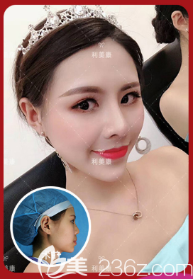 遵義利美康隆鼻案例