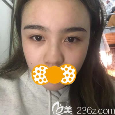 找泉州歐非劉俊醫(yī)生做鼻頭鼻翼縮小前照片 找泉州歐非劉俊醫(yī)生做鼻頭鼻翼縮小前照片