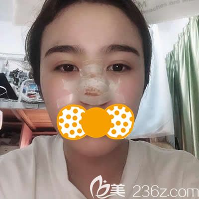 泉州歐菲劉俊醫(yī)生為我做鼻頭鼻翼縮小術后三天照片 泉州歐菲劉俊醫(yī)生為我做鼻頭鼻翼縮小術后三天照片
