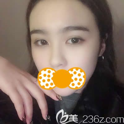 泉州歐菲劉俊醫(yī)生為我做鼻頭鼻翼縮小術后25天效果 泉州歐菲劉俊醫(yī)生為我做鼻頭鼻翼縮小術后25天效果