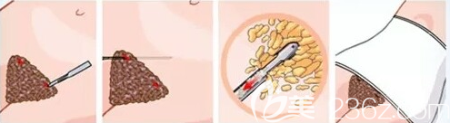 腹部吸脂手術(shù)過程示意圖