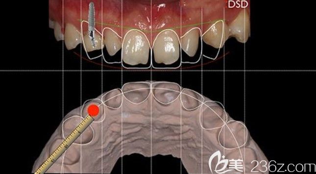 李小霞優(yōu)勢項目DSD微笑設(shè)計 李小霞優(yōu)勢項目DSD微笑設(shè)計
