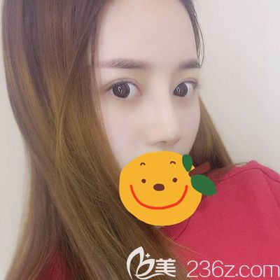 洛陽(yáng)毛大夫隆鼻術(shù)后30天效果