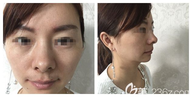 面診連云港華美術(shù)前面部初老明顯 面診連云港華美術(shù)前面部初老明顯