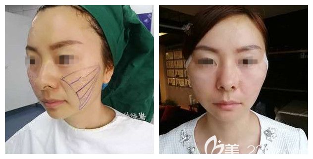 面診劃線后剛做<span style= 面診劃線后剛做<span style=