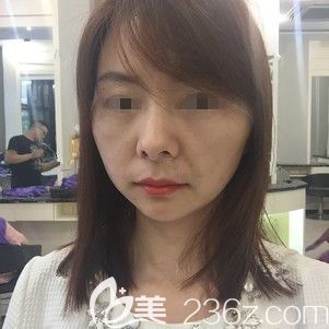 術(shù)后3天面部埋線還有些腫脹 術(shù)后3天面部埋線還有些腫脹