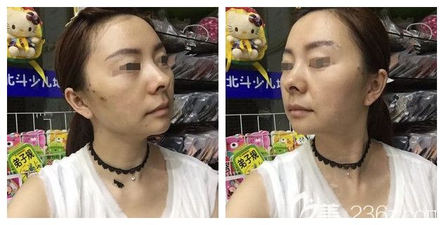 一周后埋線提升位置針眼還在恢復(fù) 一周后埋線提升位置針眼還在恢復(fù)