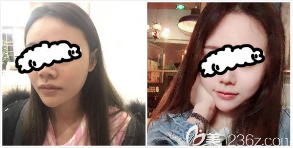 我打玻尿酸豐蘋果肌前后效果圖