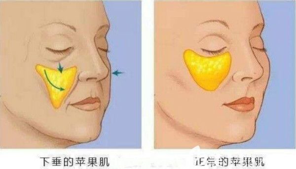 關(guān)于打了玻尿酸豐蘋果肌后是否會下滑介紹