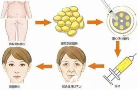 體脂肪移植填充面部過(guò)程示意圖