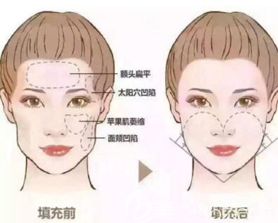 自體脂肪填充面部前后效果示意圖解
