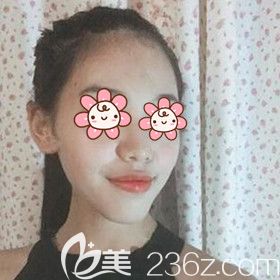 做自體脂肪填充面部術(shù)前照 做自體脂肪填充面部術(shù)前照