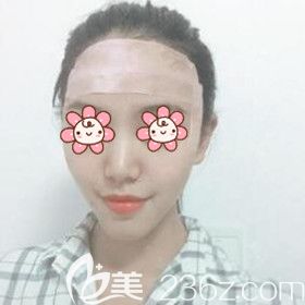 自體脂肪填充額頭術(shù)后第2天 自體脂肪填充額頭術(shù)后第2天