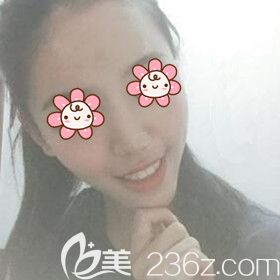 在湘潭雅美做自體脂肪填充額頭術(shù)后15天<span style= 在湘潭雅美做自體脂肪填充額頭術(shù)后15天<span style=