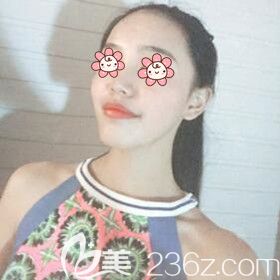 做完自體脂肪填充面部術(shù)后30天<span style= 做完自體脂肪填充面部術(shù)后30天<span style=