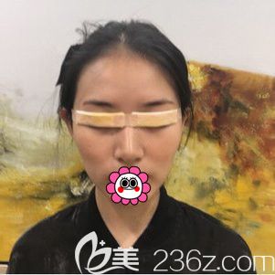 寧波藝星做雙眼皮術(shù)后即刻 寧波藝星做雙眼皮術(shù)后即刻