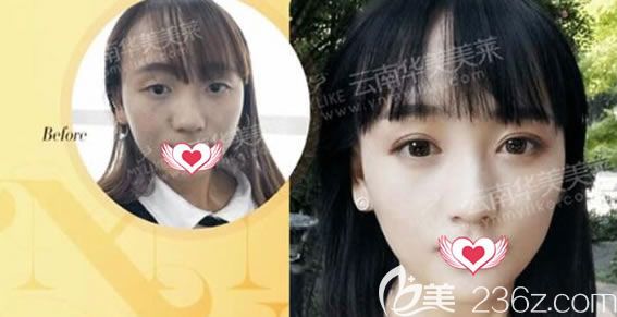 做韓式全切雙眼皮效果 做韓式全切雙眼皮效果