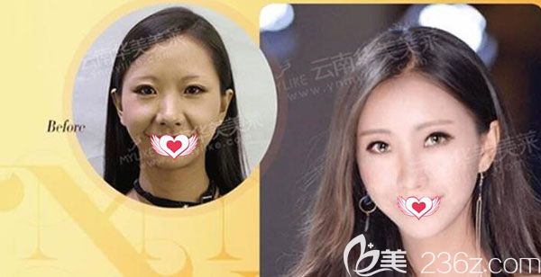 華美美萊宋萍注射效果對(duì)比圖 華美美萊宋萍注射效果對(duì)比圖