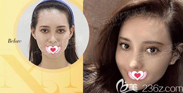 李大鐵全臉注射玻尿酸效果對(duì)比圖 李大鐵全臉注射玻尿酸效果對(duì)比圖