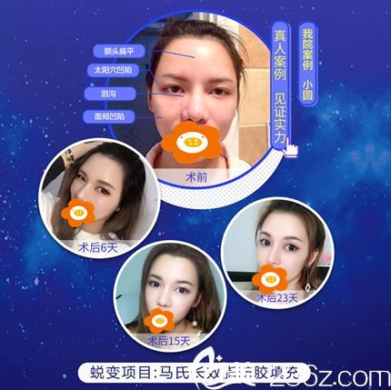 張慧慧醫(yī)生自體脂肪填充全臉效果圖