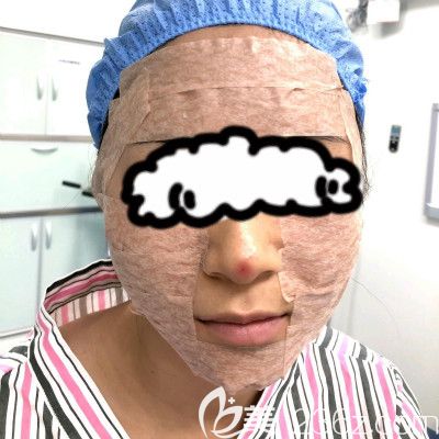 贛州葉子醫(yī)療美容鐘林輝給我做自體脂肪填充全臉術后即刻效果圖 贛州葉子醫(yī)療美容鐘林輝給我做自體脂肪填充全臉術后即刻效果圖