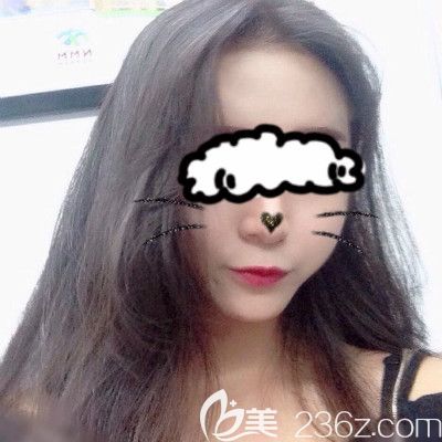 贛州葉子醫(yī)療美容鐘林輝給我做自體脂肪填充全臉術后第20天照片 贛州葉子醫(yī)療美容鐘林輝給我做自體脂肪填充全臉術后第20天照片