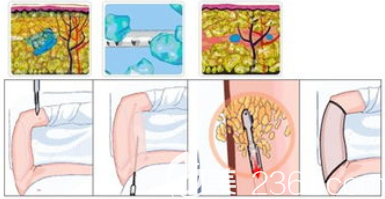 手臂吸脂手術(shù)過程圖