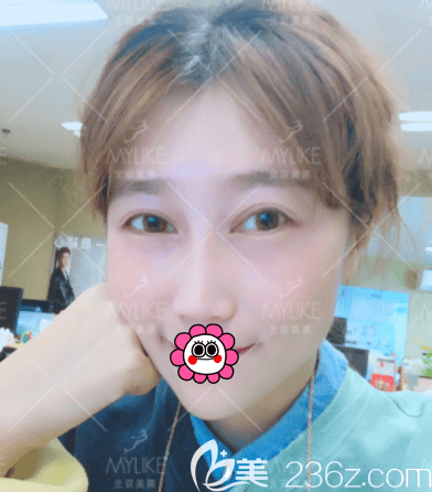 北京美萊做眼睛好的葉宇醫(yī)生給我做眶隔脂肪釋放和祛眼袋一個(gè)月效果 北京美萊做眼睛好的葉宇醫(yī)生給我做眶隔脂肪釋放和祛眼袋一個(gè)月效果