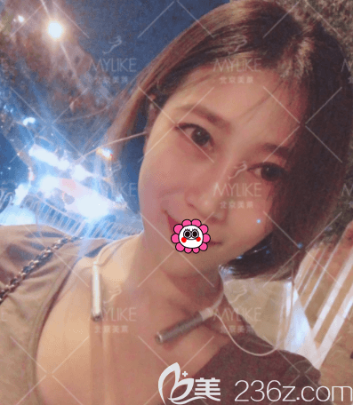 北京美萊葉宇醫(yī)生眶隔脂肪釋放+內(nèi)路祛眼袋案例 北京美萊葉宇醫(yī)生眶隔脂肪釋放+內(nèi)路祛眼袋案例